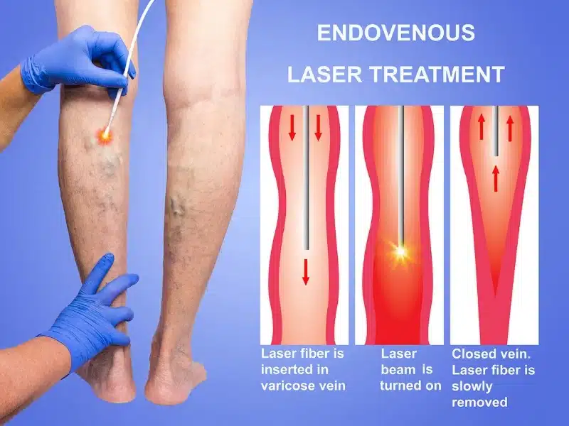 Endovenou Laser ablation of varicose veins