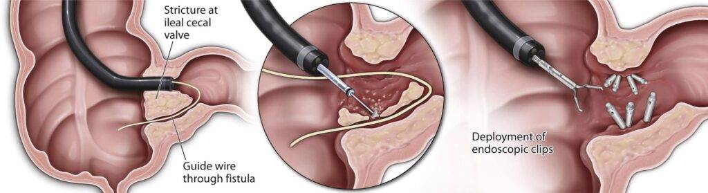 Fistula Treatment