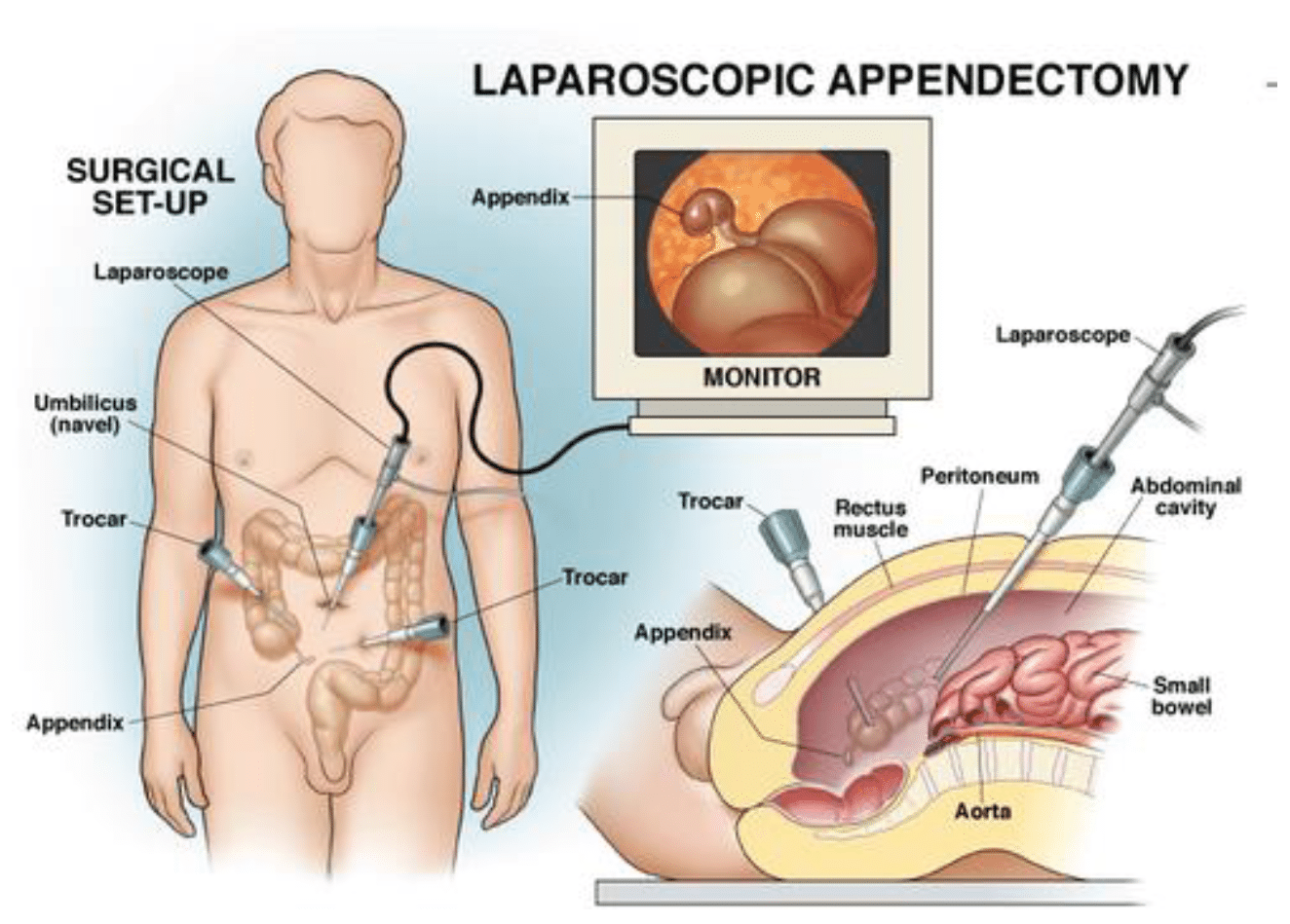 Laparoscopic Appendix Surgery