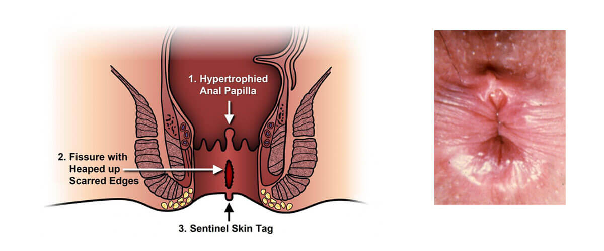 Fissure Treatment