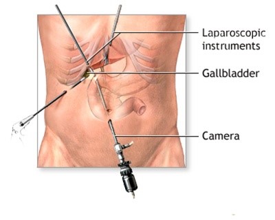Gallbladder Surgery