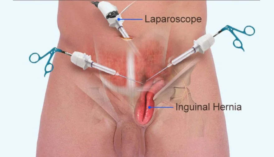 Laparoscopic Hernia Surgery