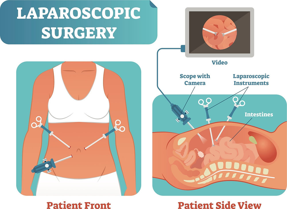 Laparoscopic surgery