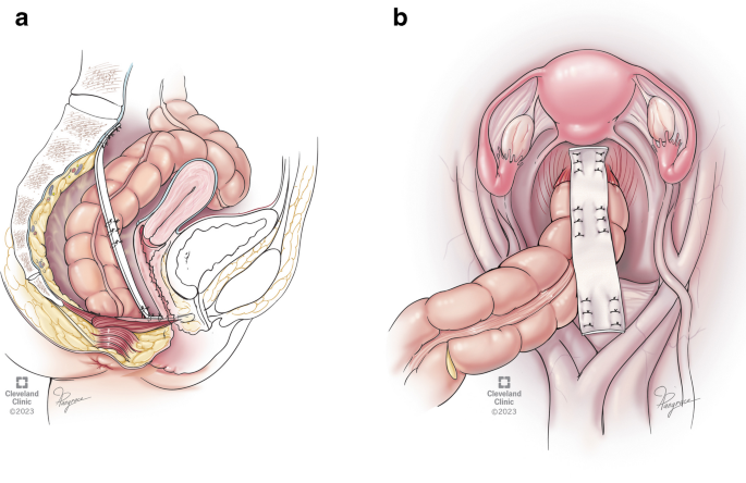 Ventral Rectopexy Surgery